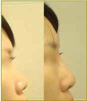 微晶瓷玻尿酸隆鼻效果前后對比
