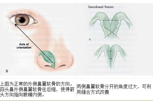 臺(tái)灣風(fēng)華蒜頭鼻治療